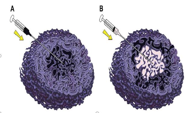 大面积婴儿血管瘤,婴幼儿血管瘤的危险因素