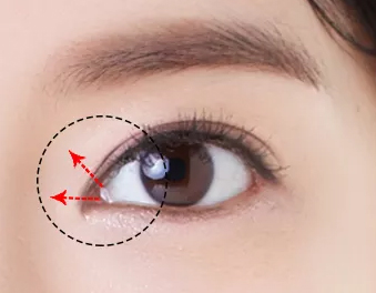 睑裂短内眦距离较宽,内眦严重但眼距窄怎么办