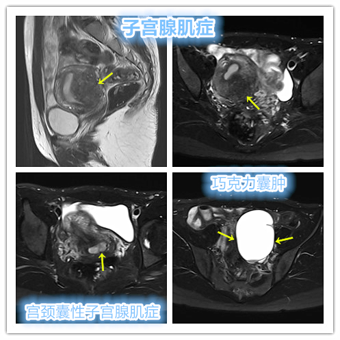 囊性子宫腺肌病的特点是什么,囊性腺肌病最佳治疗方案