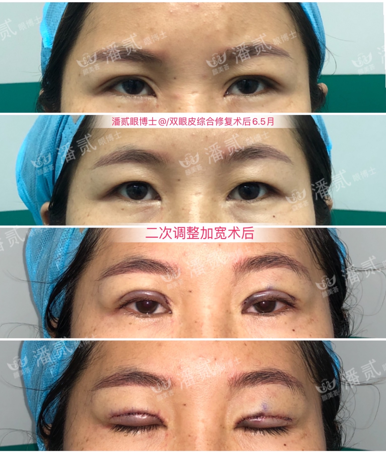 双眼皮术后变内双怎么办,双眼皮术后为啥变内双了