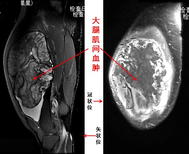 肿块一定是癌症吗,肿块是肿瘤吗