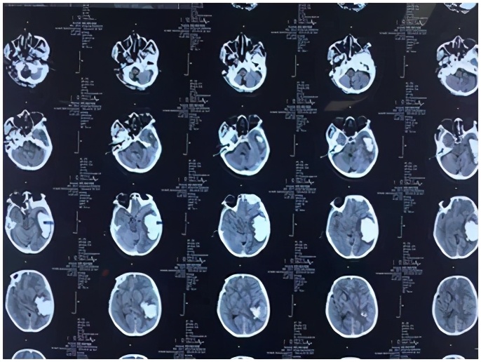 基层医院神经外科微创脑出血前景,高血压脑出血新突破