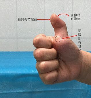 扳机指如何治疗,扳机指要怎么治疗