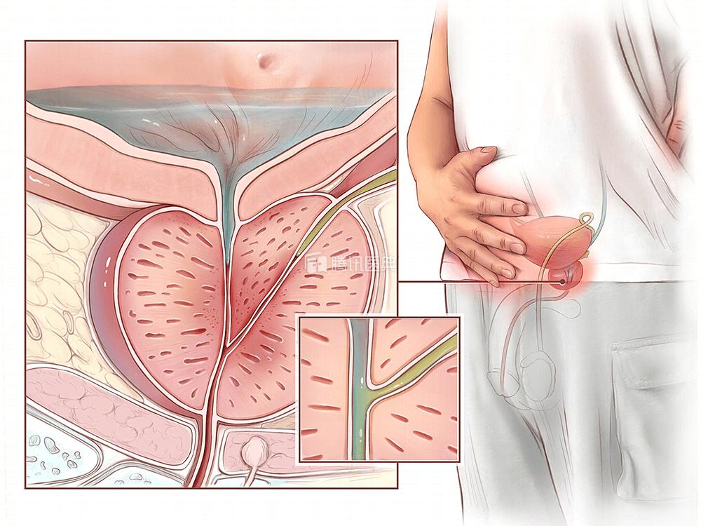 一个小妙招搞定前列腺炎,一个小动作解决前列腺炎