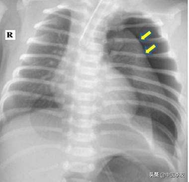 针灸过程中病症加重是什么原因,针灸异常情况的处理