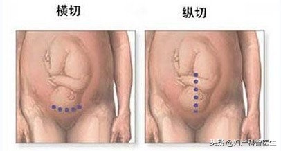 揭开产房神秘面纱,原来剖腹产有多可怕