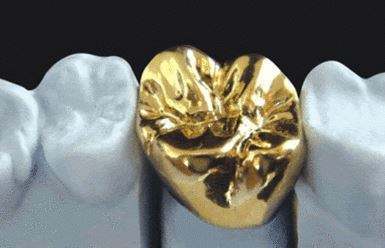 牙冠的常见种类与区别,牙冠什么种类性价比高