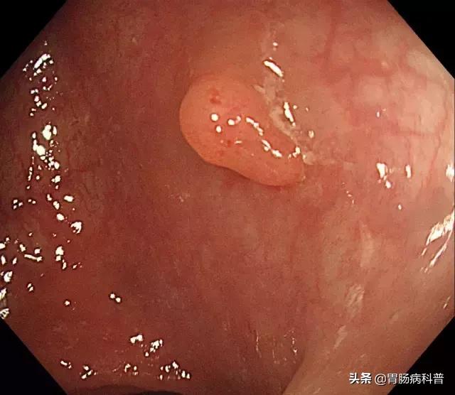 长了胃息肉怎么治疗好,长了胃息肉会有什么症状