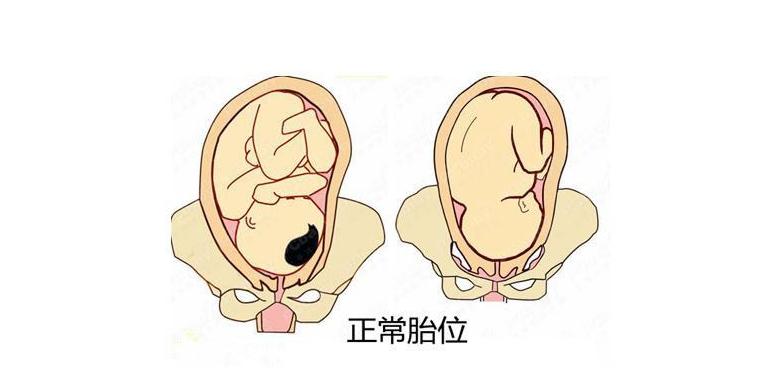 孕期胎位不正怎么办？别担心，除了纠正还有其他办法可以解决
