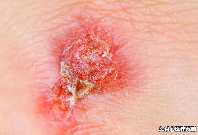 复方炉甘石抑菌洗剂都有什么妙用,炉甘石洗剂婴儿妙用