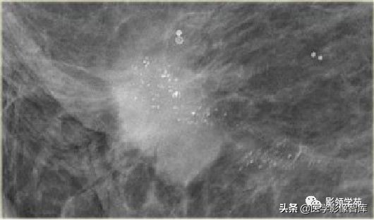 乳腺钙化怎么区分良性和恶性,乳腺钙化的诊断与分级