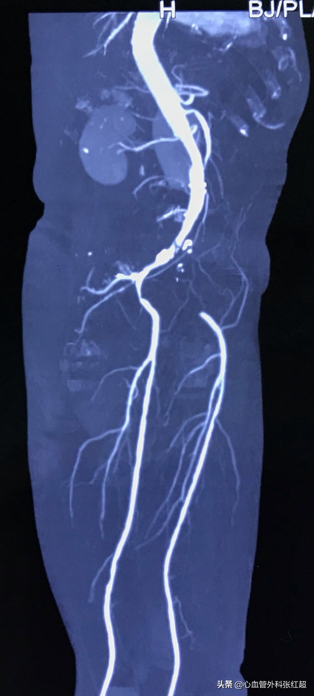外周血管治疗图,外周血管疾病怎么治