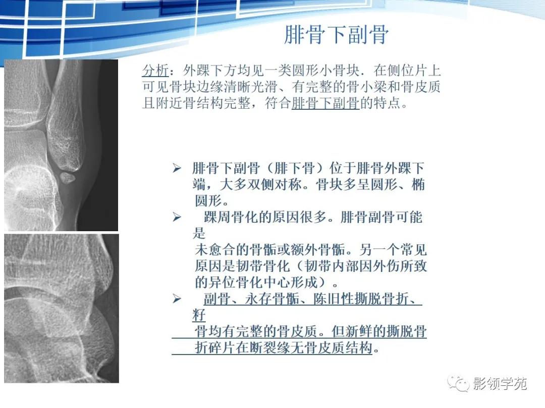桡骨远端骨折引起尺骨变异,撕脱骨折一个月无明显骨痂形成