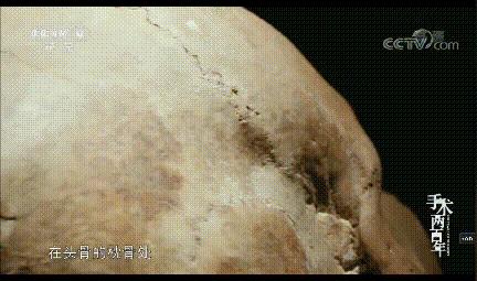 极限挑战医学解剖模型,极限挑战全肠道破损