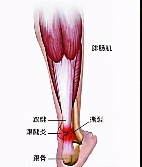 跟腱炎是跟腱断裂的前兆吗,预防跟腱断裂的几个征兆