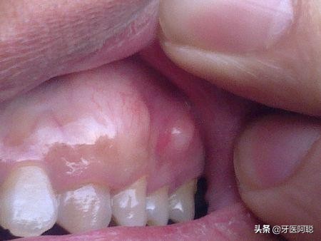牙槽骨肿了不疼怎么回事,牙槽骨突出面部不舒服怎么办