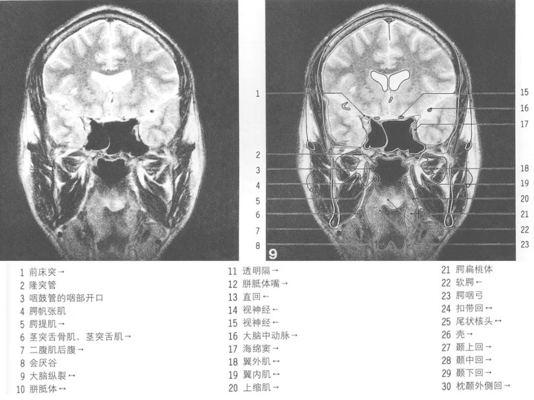 颅脑冠状状切面解剖图,颅脑mr解剖结构图
