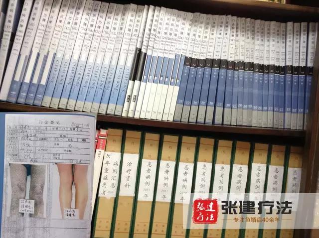 鱼鳞病张建疗法是真的吗,长沙张建疗法鱼鳞病靠谱吗