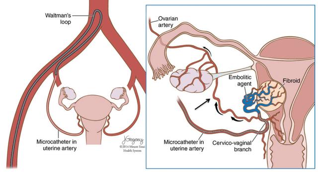 皮肌炎合并卵巢癌晚期怎么治疗,奥拉帕利治疗卵巢癌晚期效果好吗
