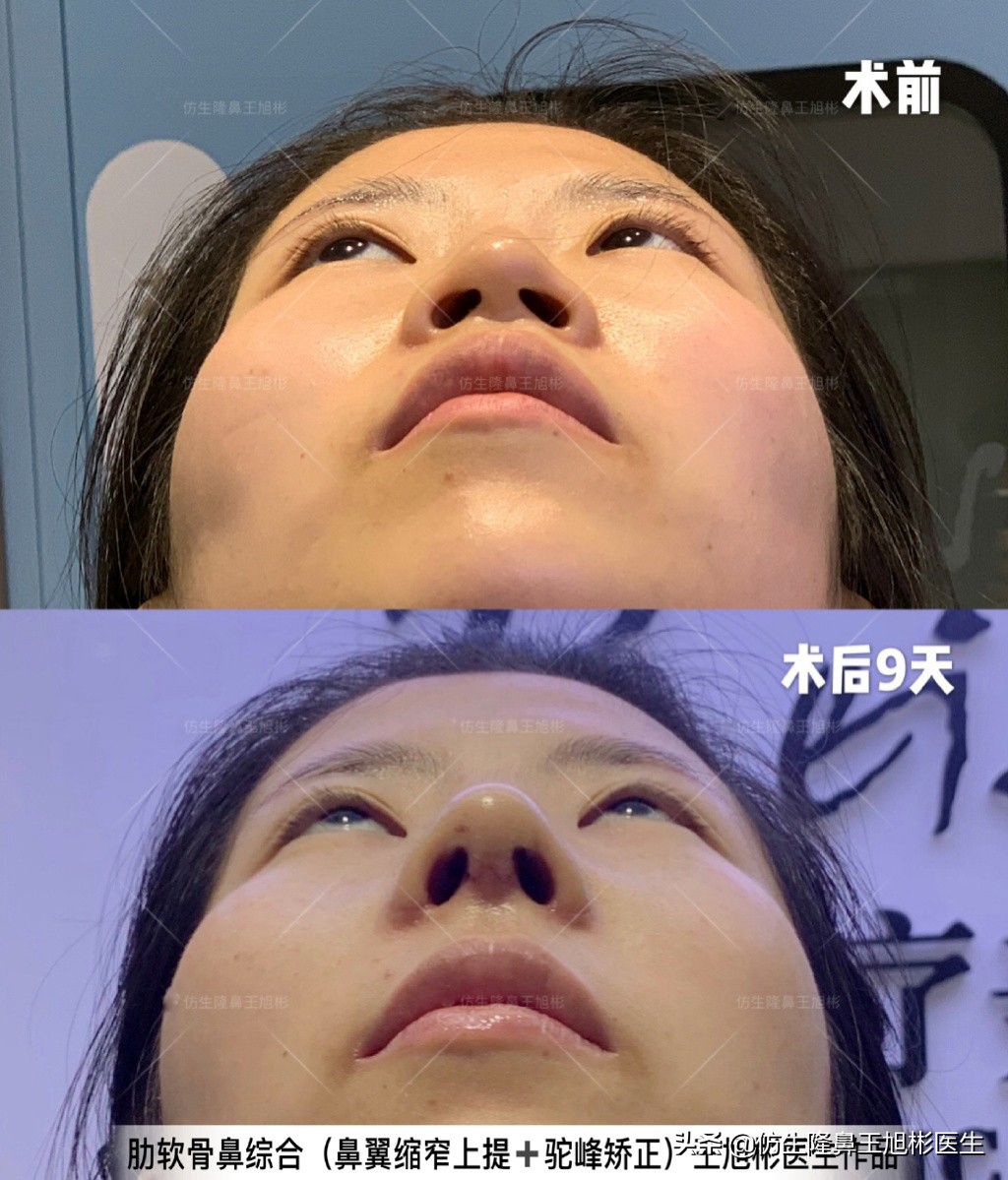 鼻头和鼻小柱是如何抬高的,鼻头扁是什么预兆