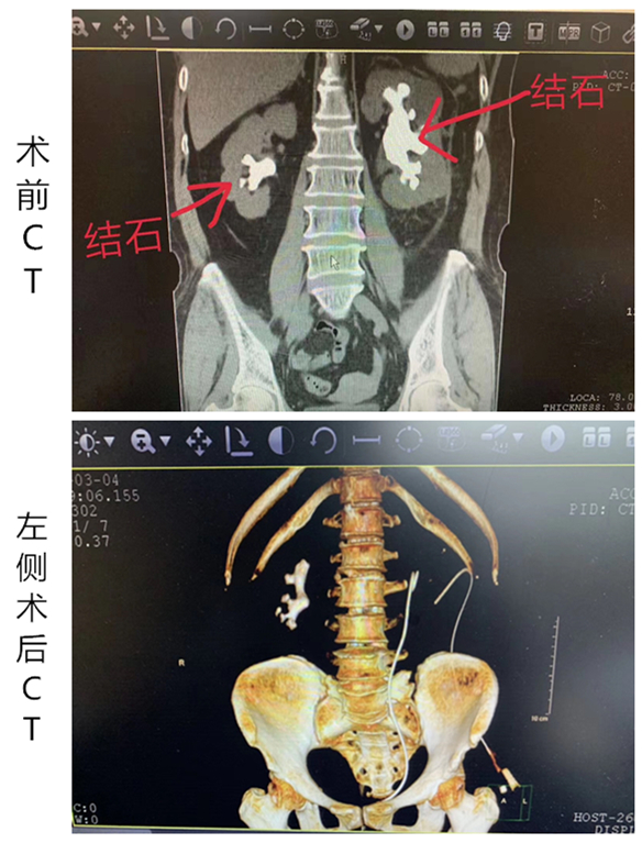 左肾长满鹿角结石,大妈肾内结石