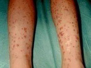 过敏性紫癜儿童的治疗方法及用药,儿童过敏性紫癜复查需要复查血吗