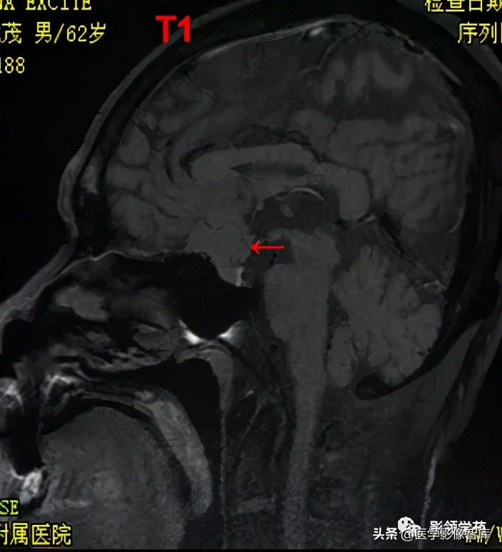 鞍区肿瘤做什么检查得出来,鞍区肿瘤的影像学鉴别