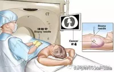 肺癌诊断与微创综合治疗,肺癌晚期的微创介入治疗