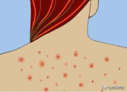 脸上长痘痘前胸长痘痘背后长痘痘,背后长痘痘的原因和改善方法