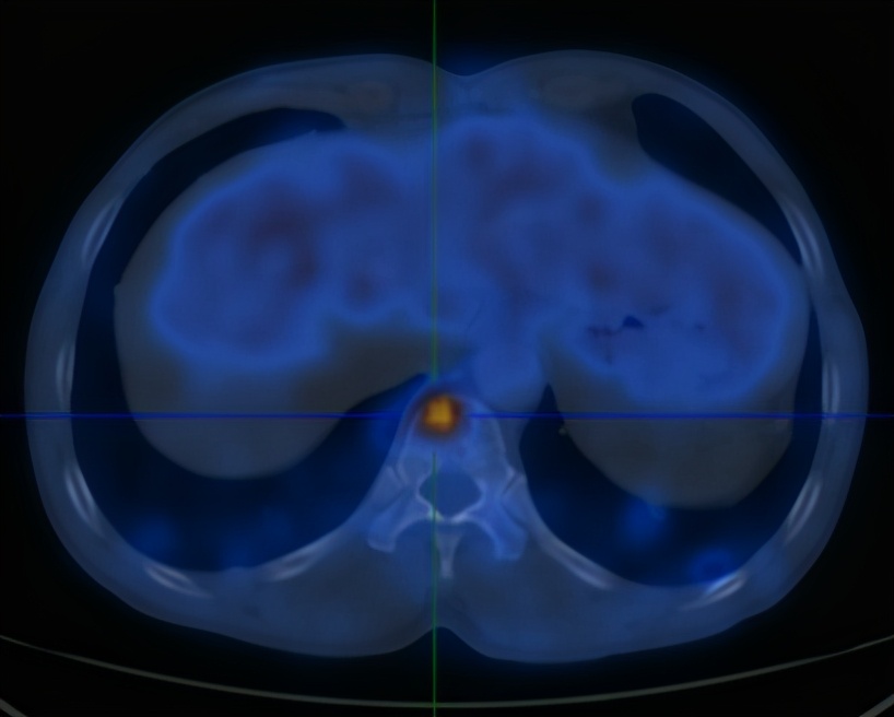 腰痛与肺癌有关吗,腰痛的厉害是得了肾癌吗