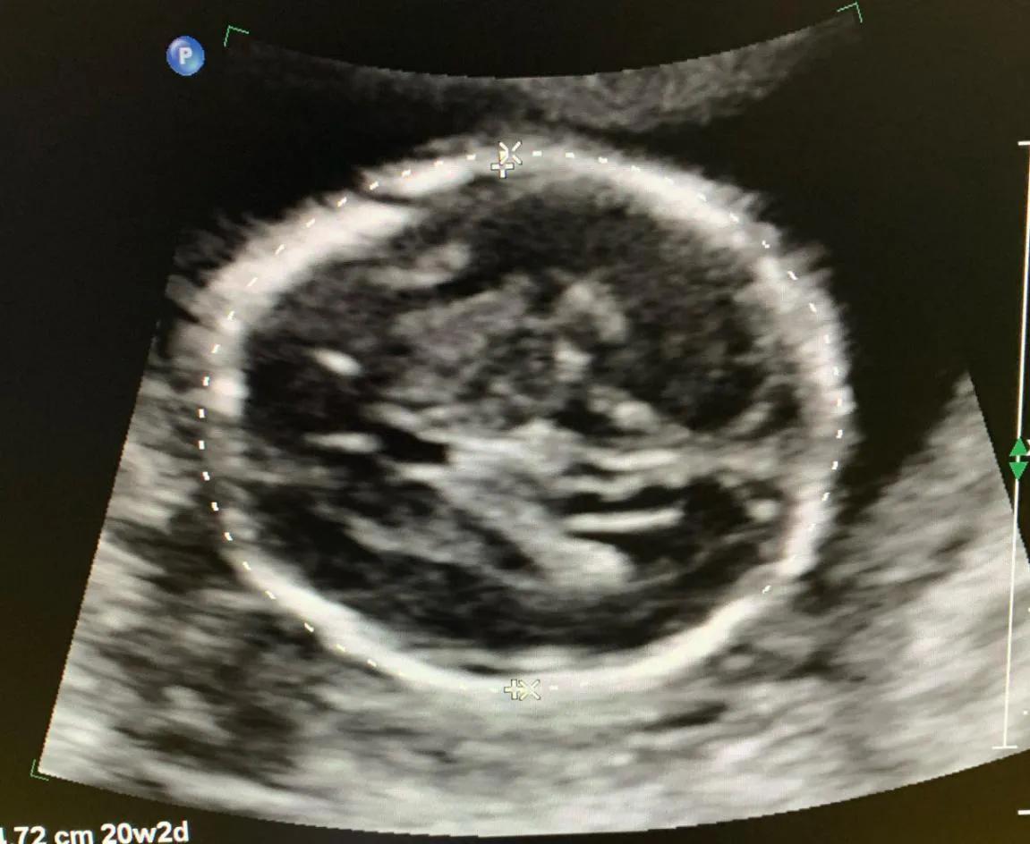 孕期非要不可的几次超声检查，孕妈妈再忙也要做！