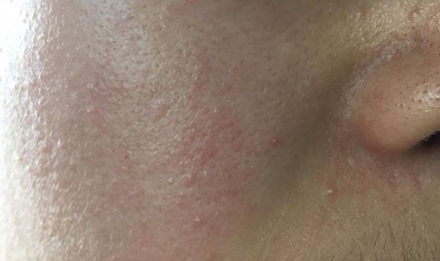 鼻翼总是红红的是什么原因,鼻翼长痘痒痒的红红的