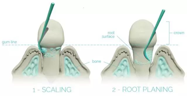 为什么都是洗牙，价格却不一样？了解一下这4种洗牙技术
