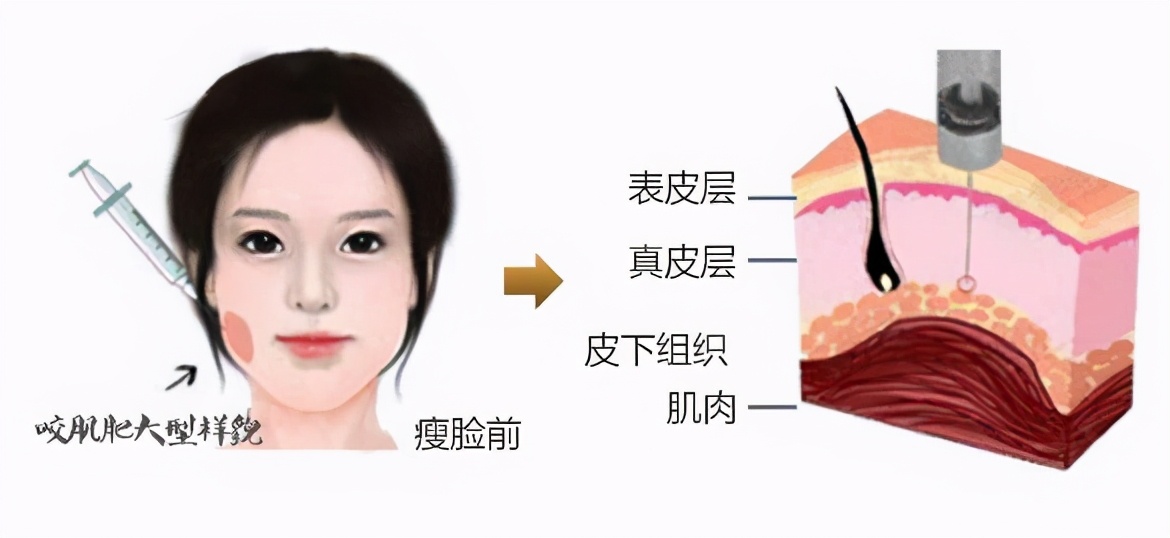 微整形瘦脸的小知识,面部微整形瘦脸方法