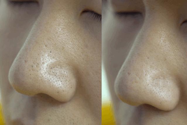 长黑头VS不长黑头差距这么大?精致女孩如何绕过黑头这道坎?