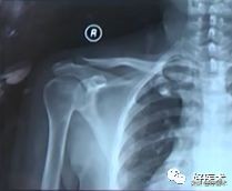 肩锁关节脱位手术后多久可以喝酒,肩锁关节脱位钢板内固定步骤记录