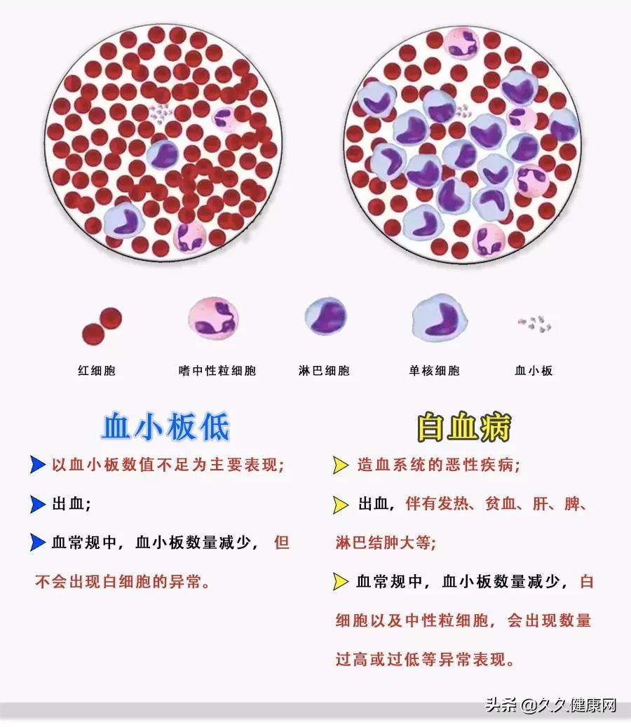 血小板低意味着就是白血病吗,血小板低是白血病是血癌吗