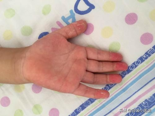 少儿川崎病,川崎病是什么样子的儿童