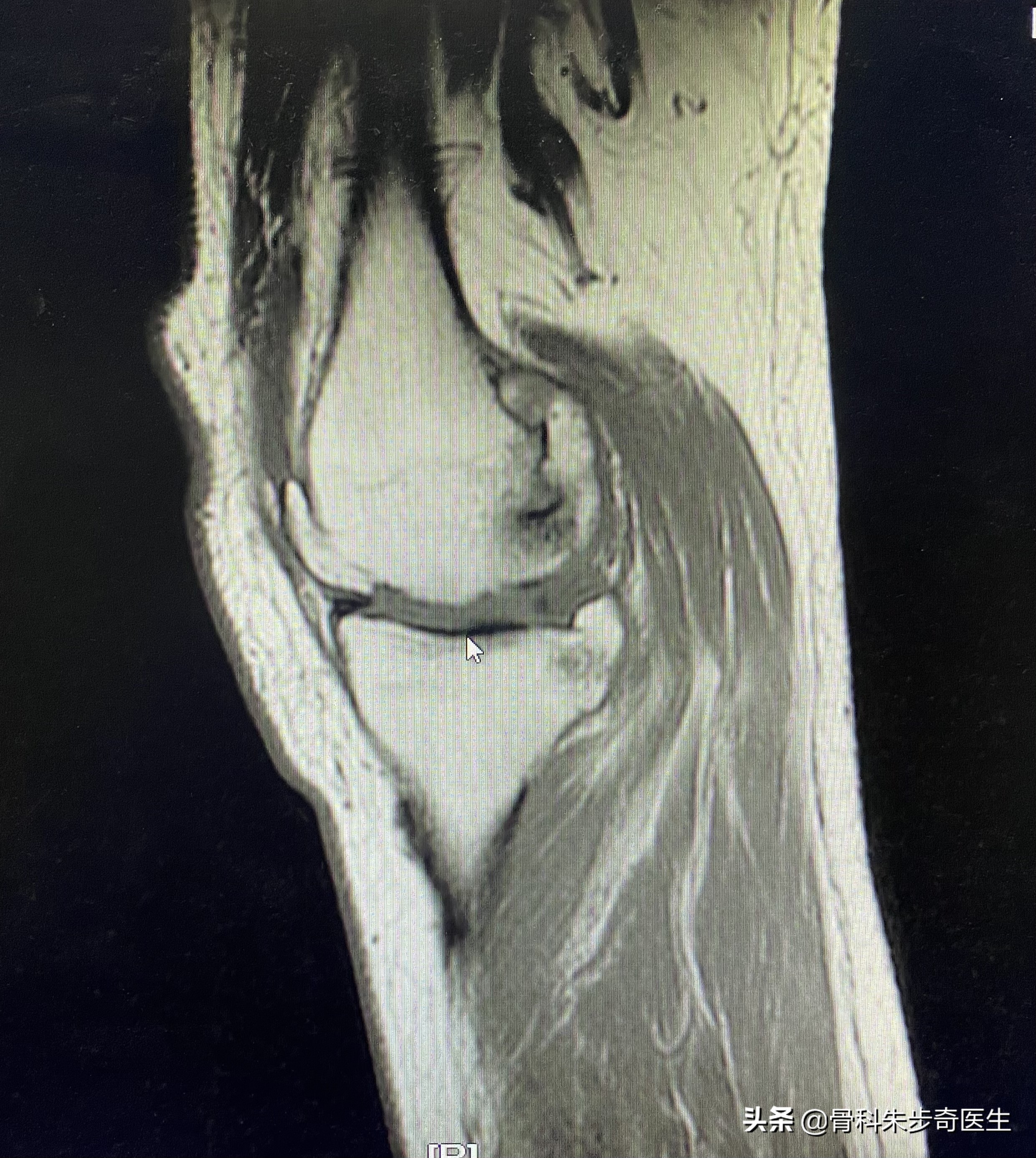 膝关节上面的骨刺该怎么解决,年轻人膝关节骨刺是怎样引起的