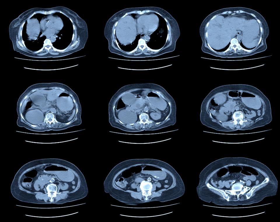 美国癌症发病率死亡率逐年下降,美国肾癌最新治愈消息