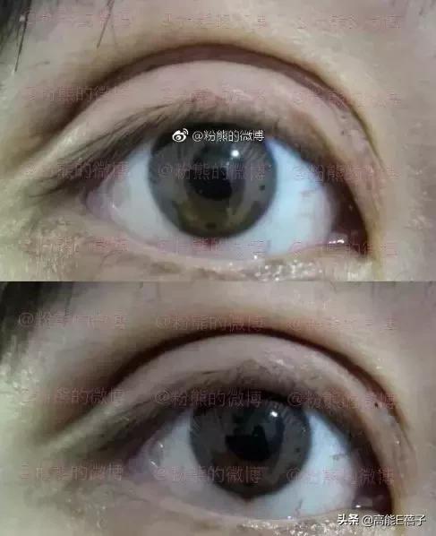 微整形需要多久,微整形后多久恢复正常