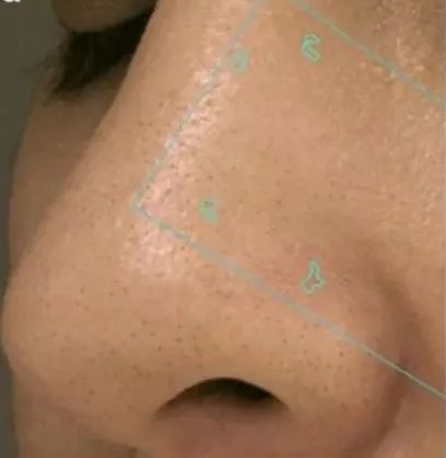 去除又黑又硬的黑头的方法,怎么祛除黑头的最有效方法