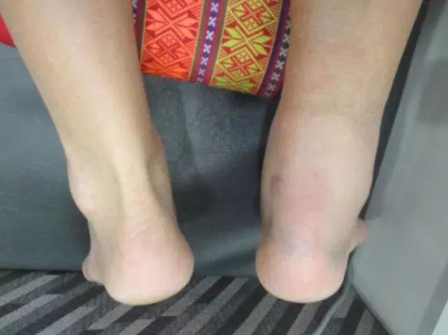 运动医学分析运动损伤案例,运动医学跟腱撕裂