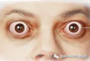 甲亢引起突眼原因,甲亢突眼是什么样子的