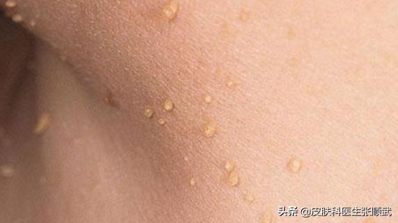皮肤上长小肉球,身体上长小肉粒能用头发去掉吗