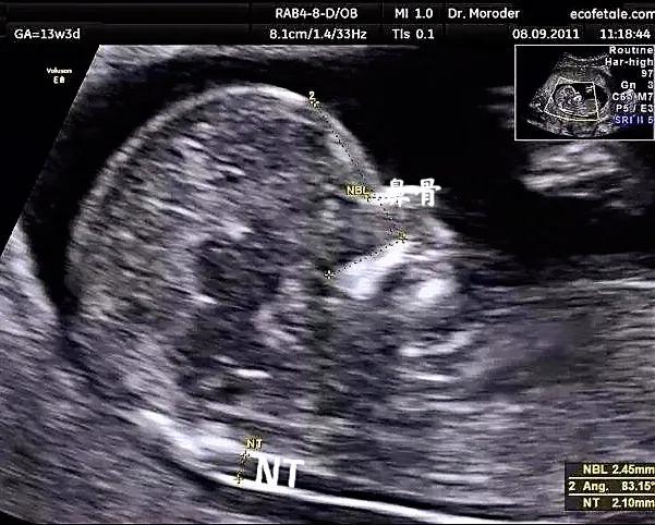 孕期非要不可的几次超声检查，孕妈妈再忙也要做！