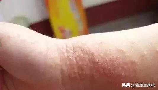 婴儿湿疹的原因和治疗方法,湿疹是什么原因造成的要怎么预防