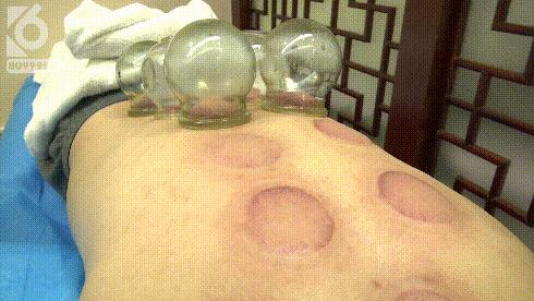 女性湿气太重拔火罐有用吗,拔火罐后有水泡是烫伤还是湿气