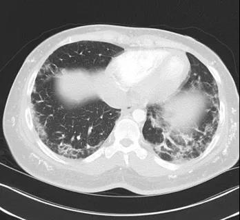 皮肌炎或多发性肌炎的诊断标准,成人皮肌炎与儿童皮肌炎区别