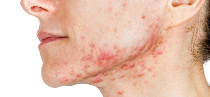 痘坑痘印消炎修复的最佳方法,是不是痘痘消炎了就有痘坑